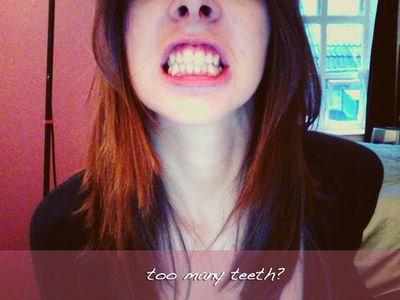 Too many teeth